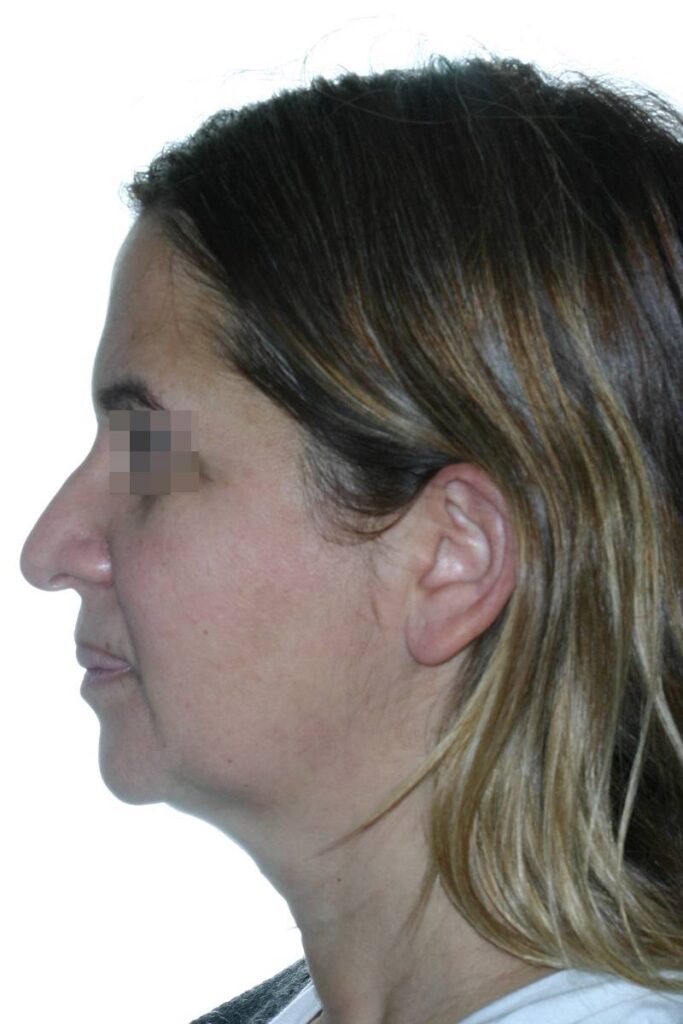 Caso clínico lifting de cara