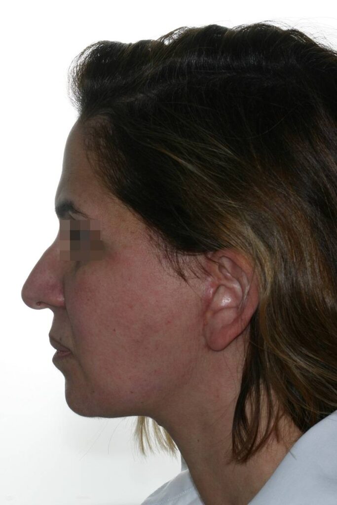 Caso clínico lifting de cara