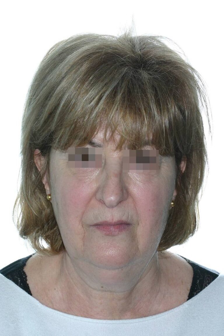 Caso clínico lifting profundo de cuello y cara