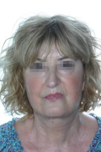 casos clinicos lifting facial