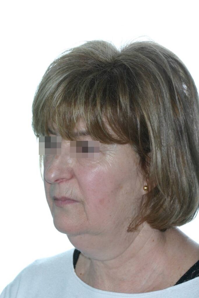 Caso clínico lifting profundo de cuello y cara