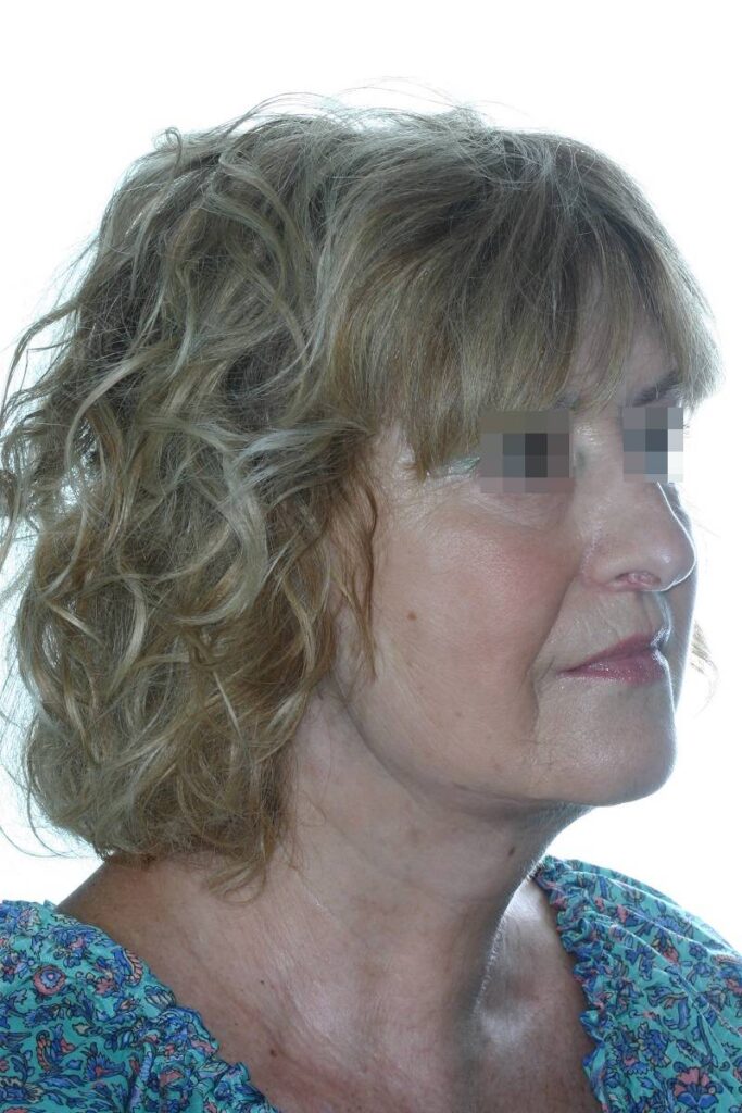 Caso clínico lifting profundo de cuello y cara