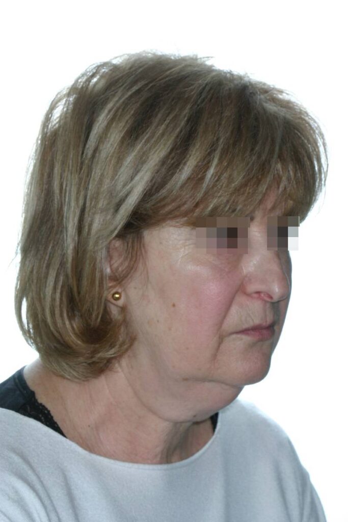 Caso clínico lifting profundo de cuello y cara