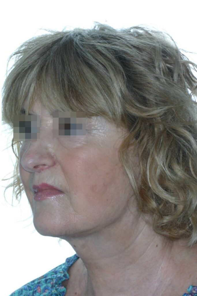 Caso clínico lifting profundo de cuello y cara