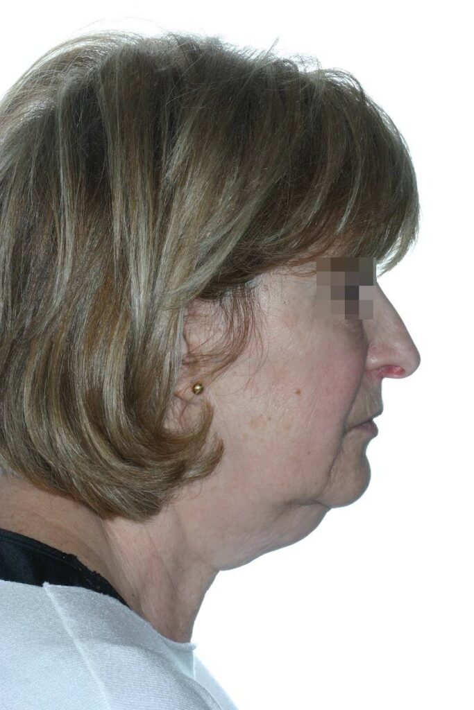 Caso clínico lifting profundo de cuello y cara