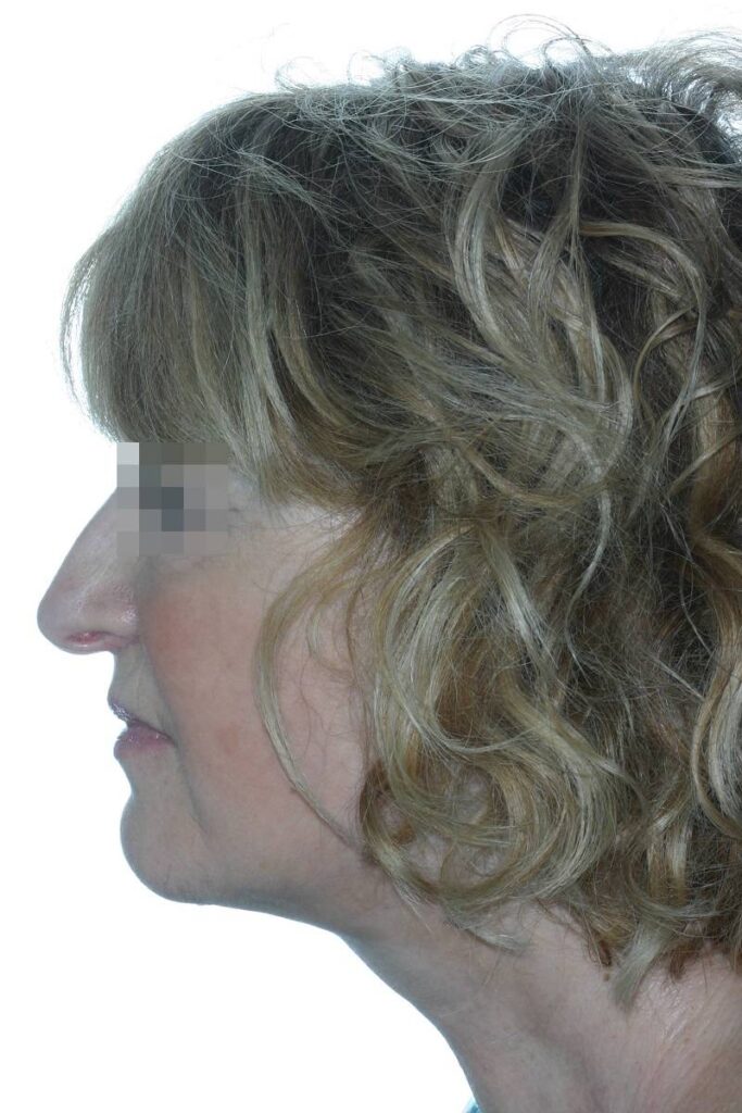 Caso clínico lifting profundo de cuello y cara