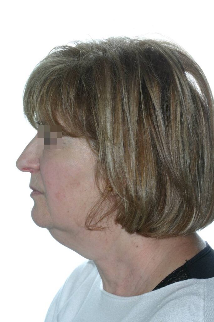 Caso clínico lifting profundo de cuello y cara