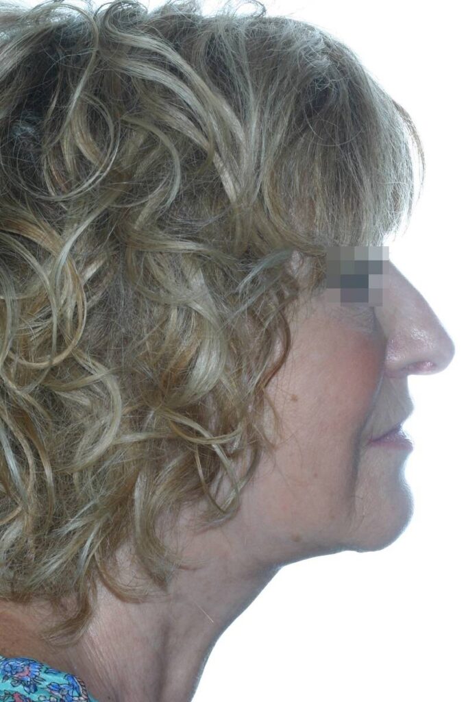 Caso clínico lifting profundo de cuello y cara