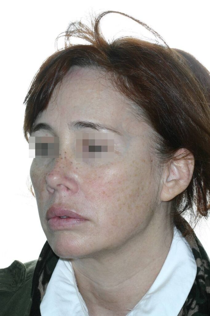 Caso clínico lip lift, lifting de cejas