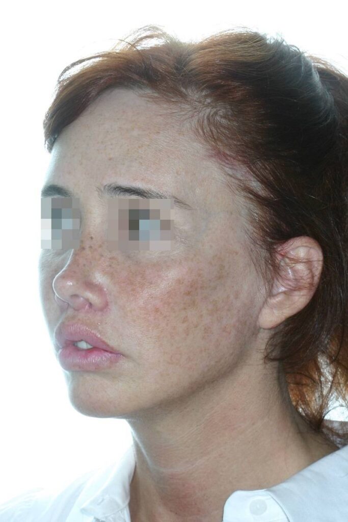 Casos clinicos lifting facial