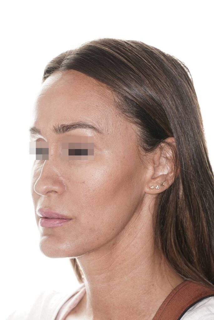 Caso clínico mentoplastia de reducción