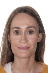 Casos clinicos mentoplastia