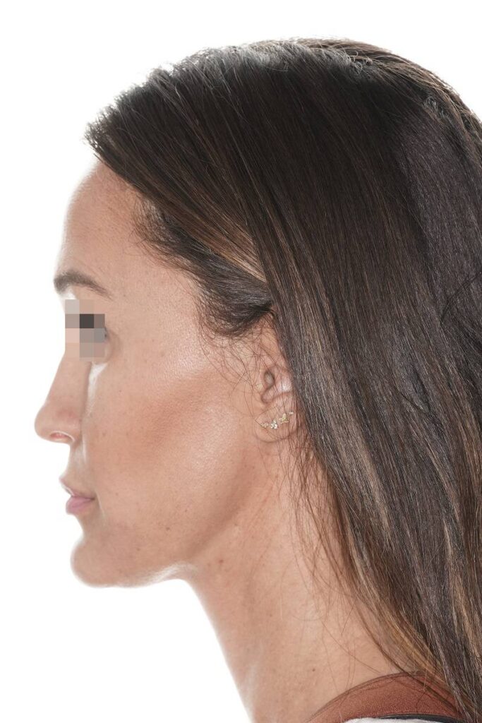 Caso clínico mentoplastia de reducción