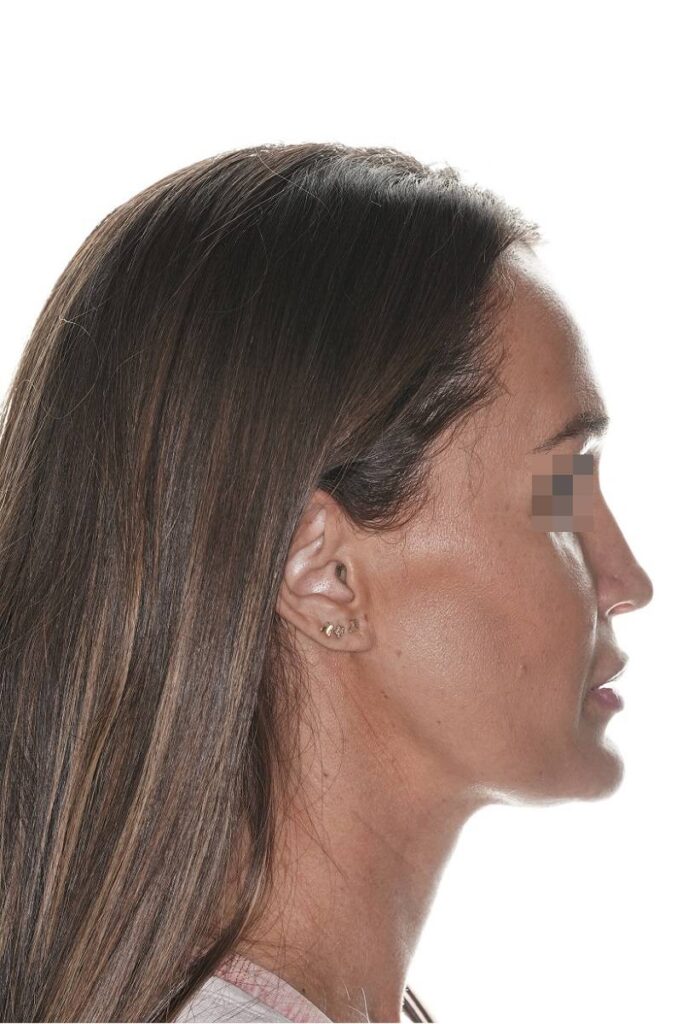 Caso clínico mentoplastia de reducción