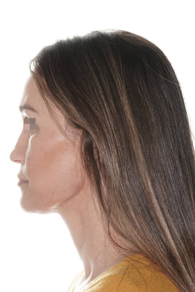 Caso clínico mentoplastia de reducción