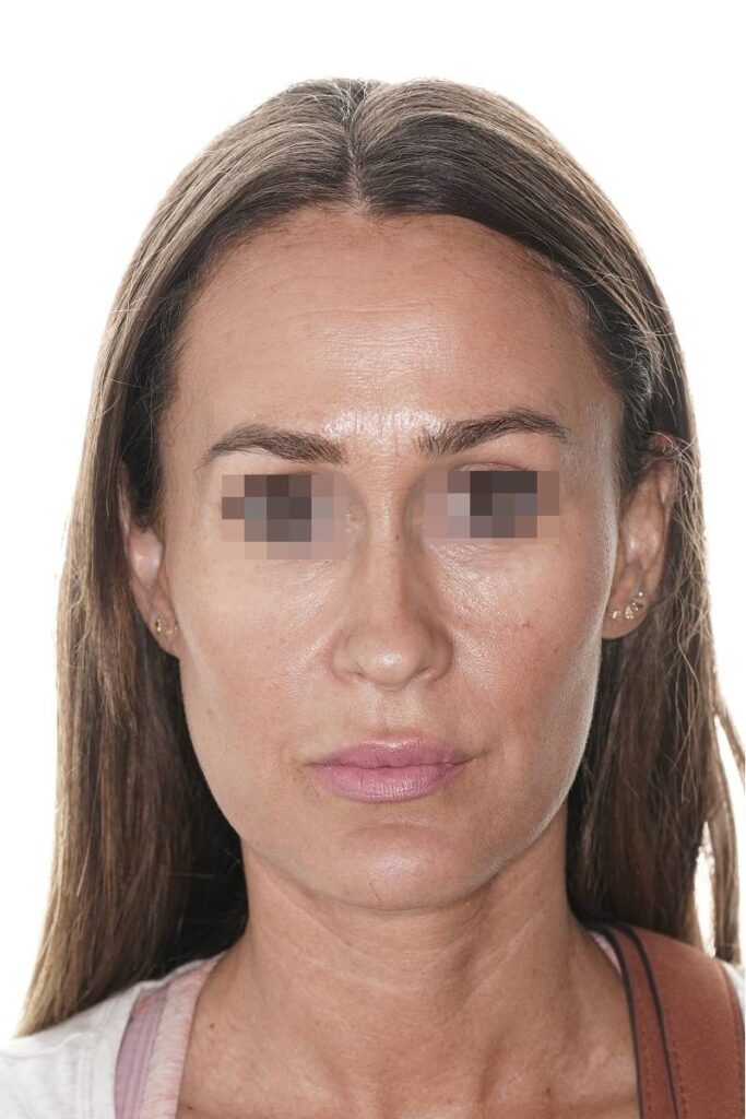 Caso clínico mentoplastia de reducción