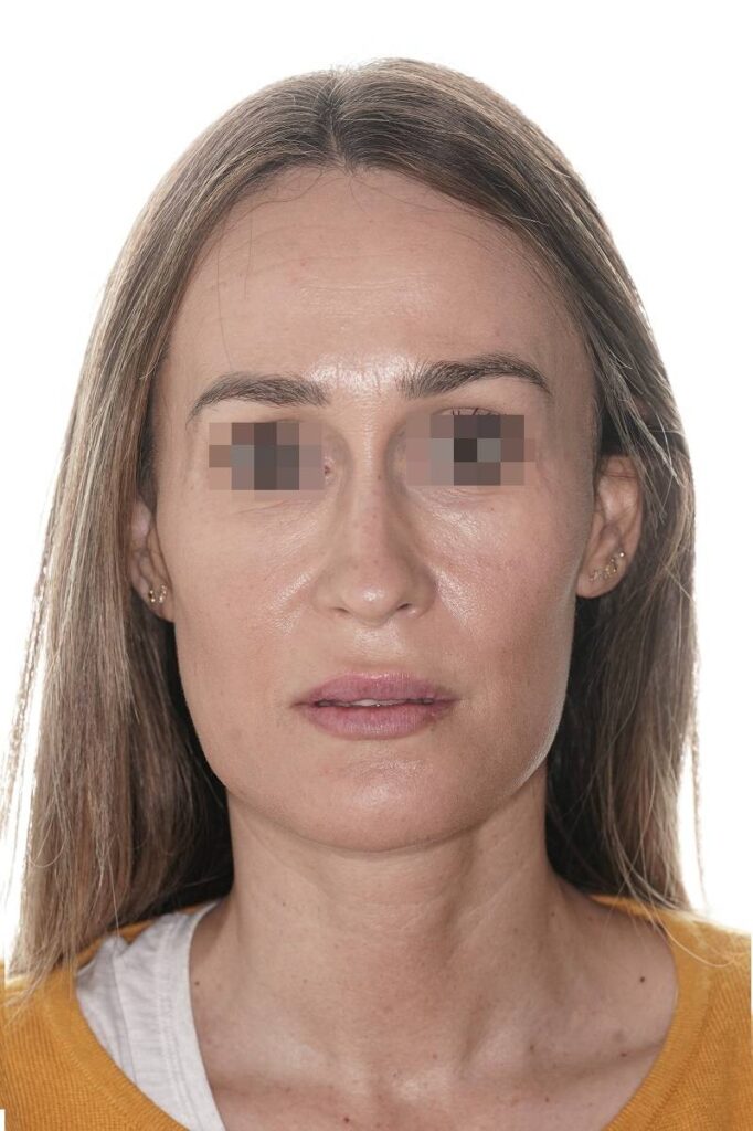 Caso clínico mentoplastia de reducción