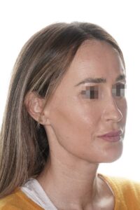 Caso clínico mentoplastia de reducción