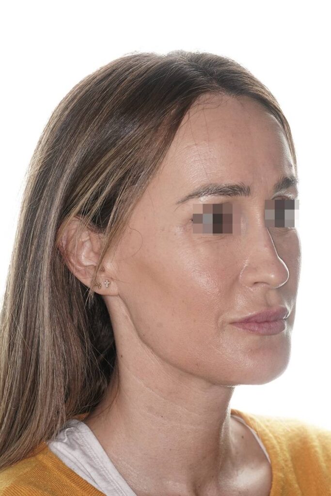 Caso clínico mentoplastia de reducción