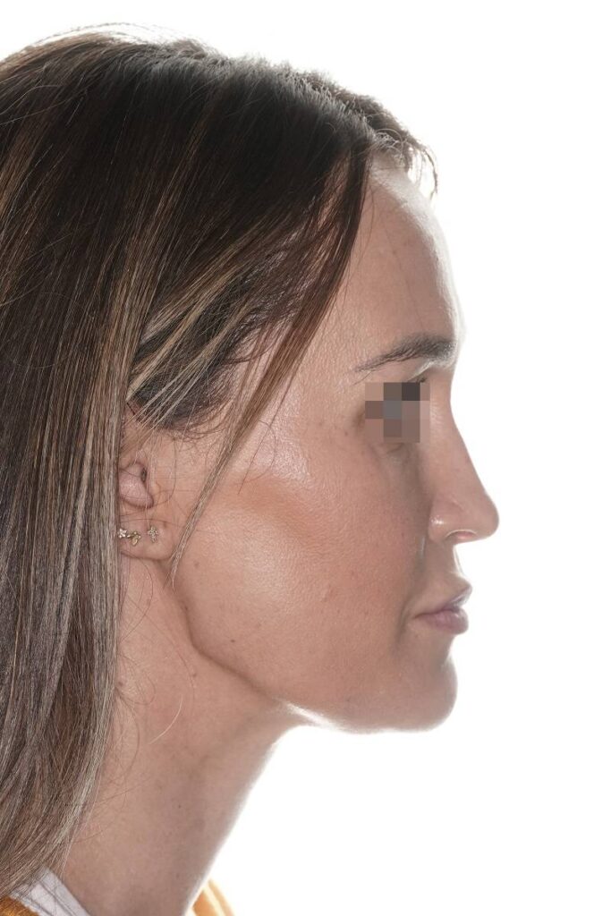 Caso clínico mentoplastia de reducción