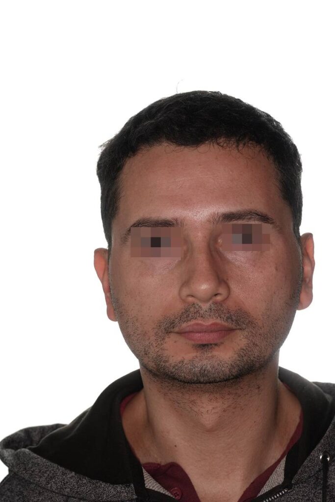 Caso clínico mentoplastia