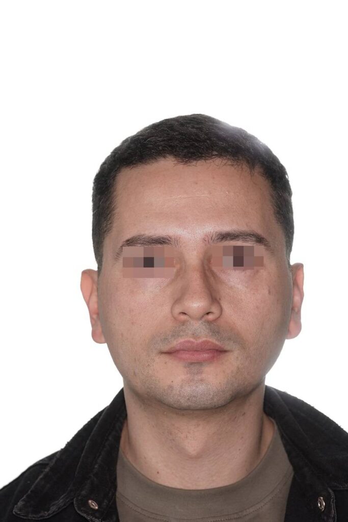 Casos clinicos mentoplastia