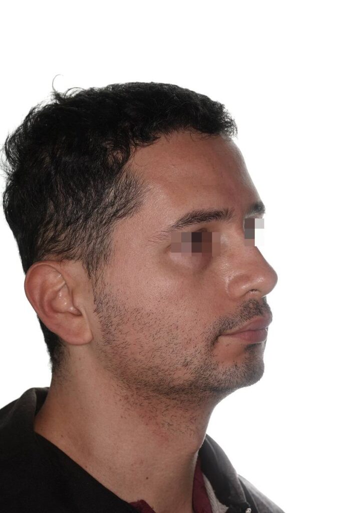 Caso clínico mentoplastia