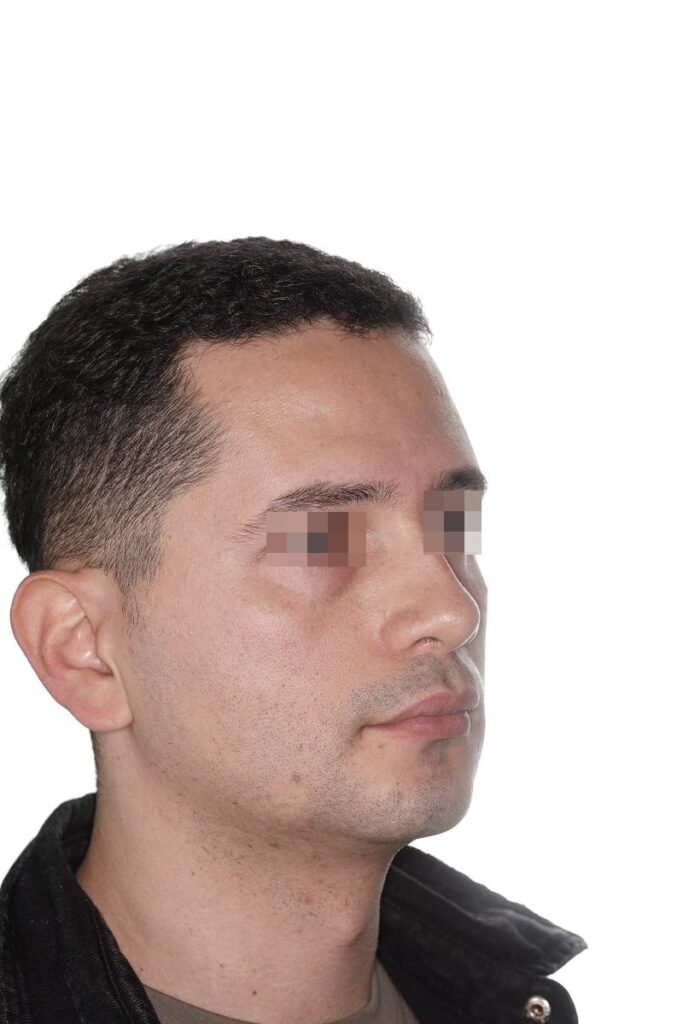 Caso clínico mentoplastia