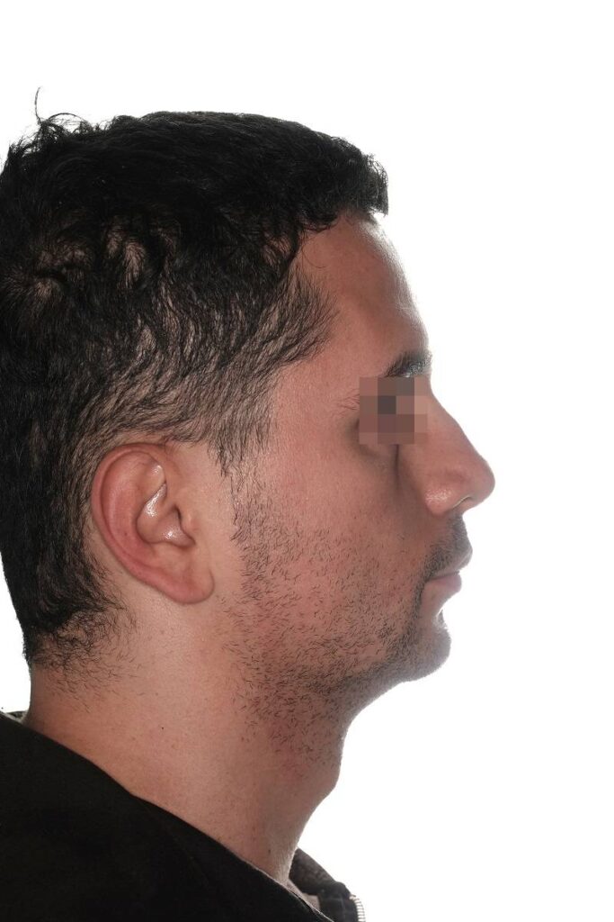 Caso clínico mentoplastia