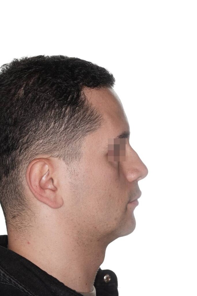 Caso clínico mentoplastia