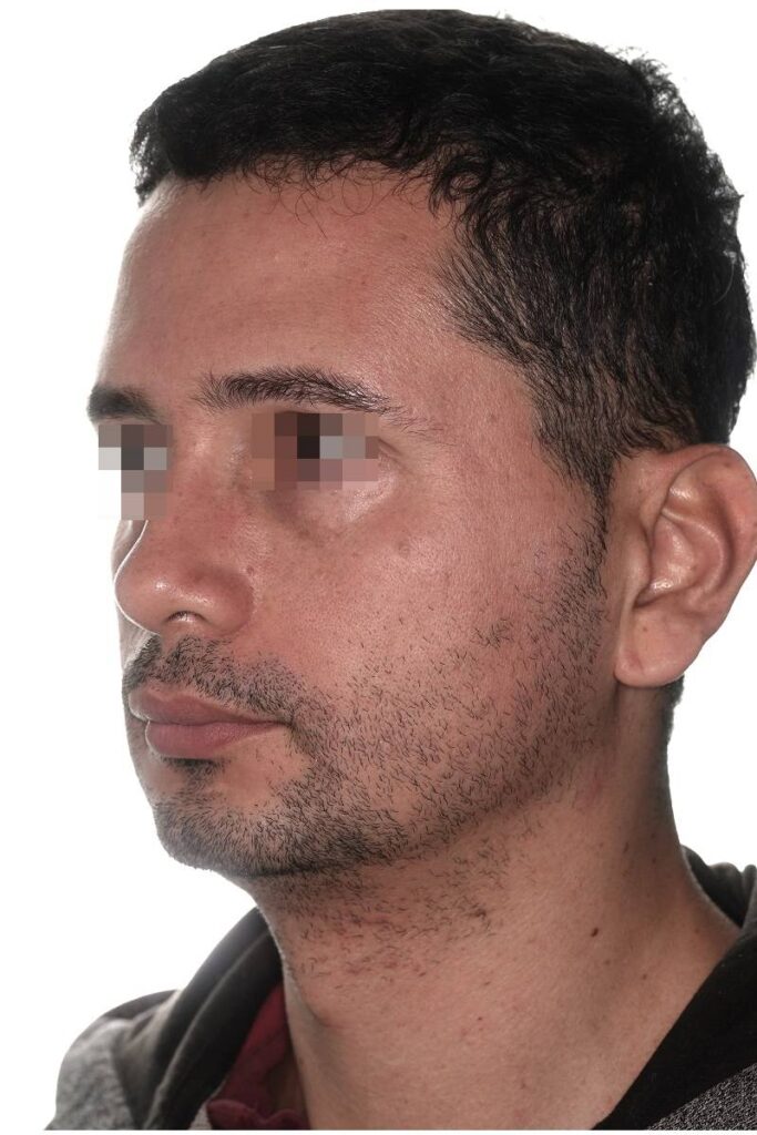 Caso clínico mentoplastia