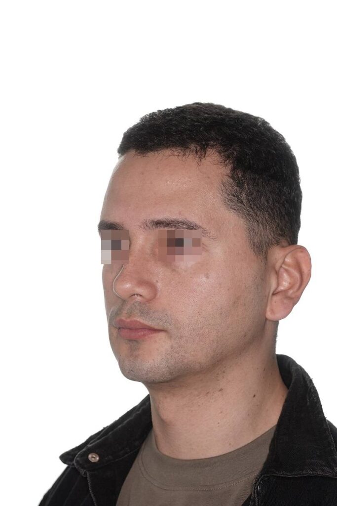 Caso clínico mentoplastia