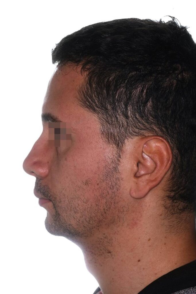 Caso clínico mentoplastia
