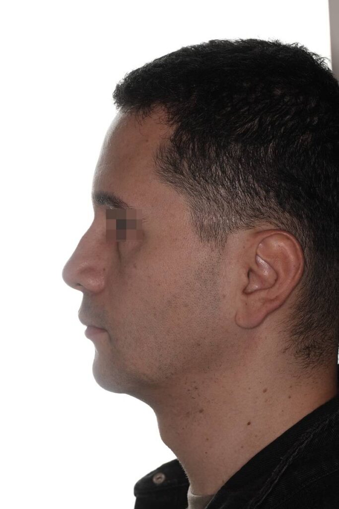 Caso clínico mentoplastia