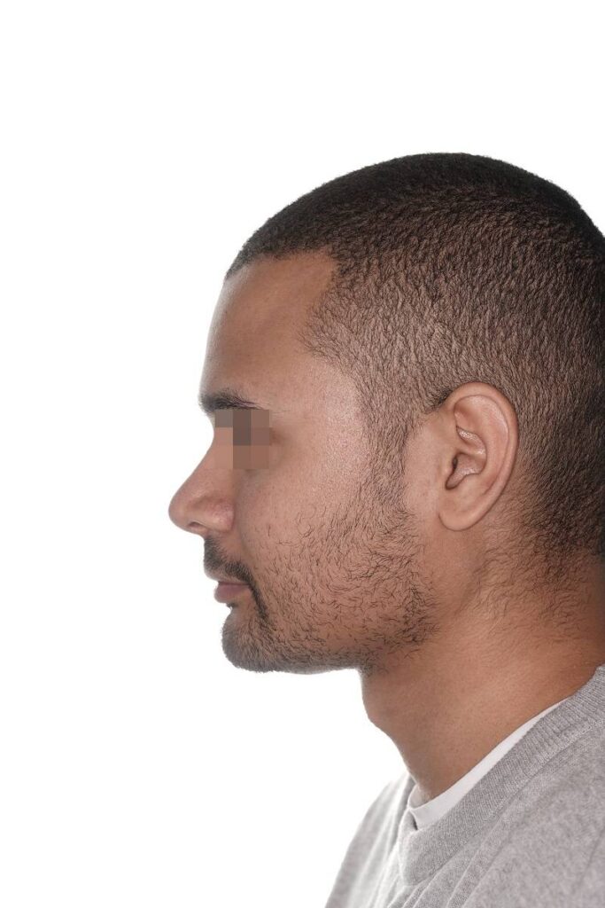 Caso clínico mentoplastia ósea