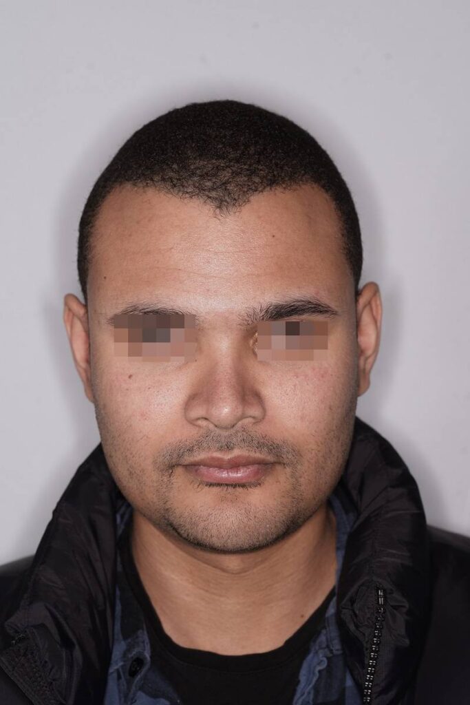 Casos clinicos mentoplastia