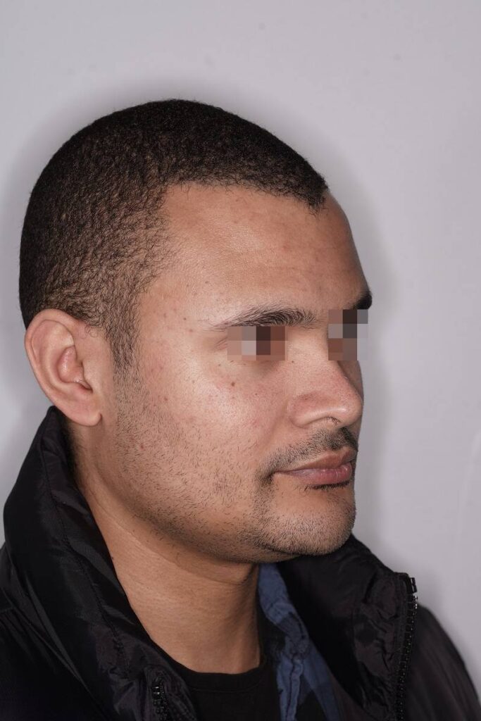 Caso clínico mentoplastia ósea