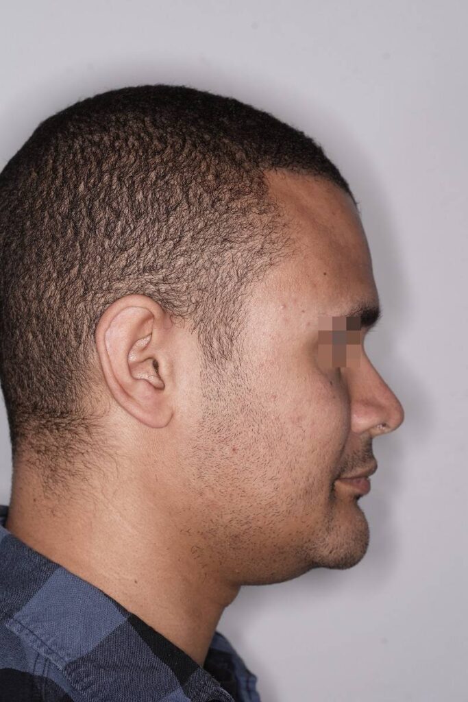 Caso clínico mentoplastia ósea