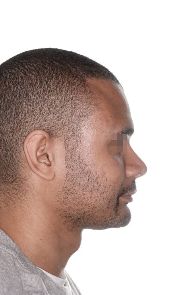 Caso clínico mentoplastia ósea