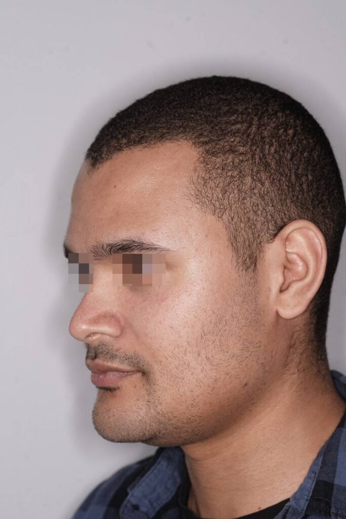 Caso clínico mentoplastia ósea