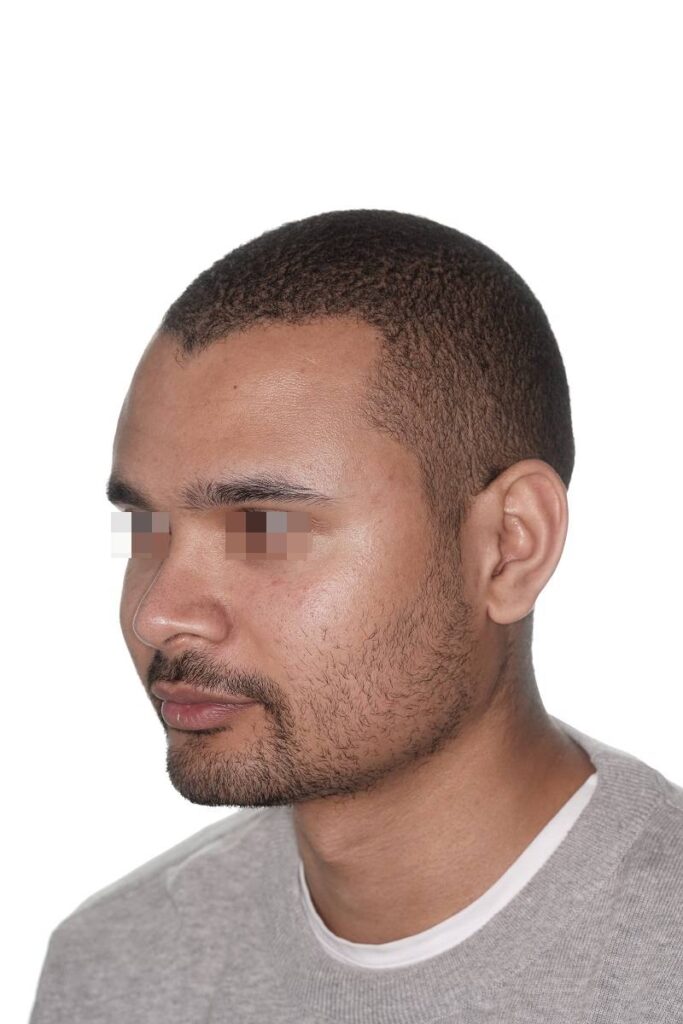 Caso clínico mentoplastia ósea