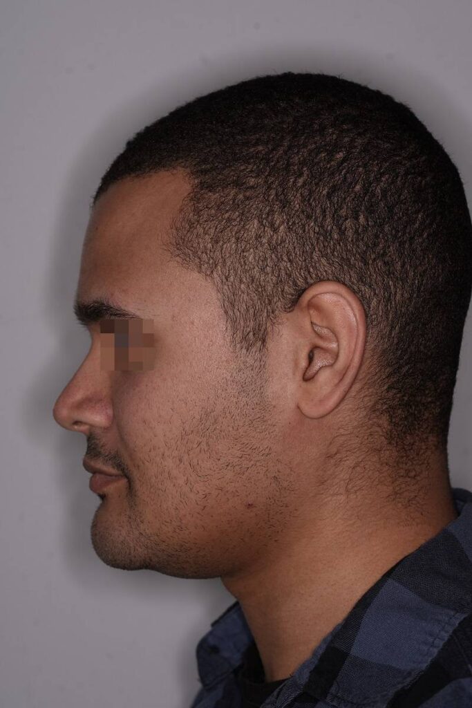 Caso clínico mentoplastia ósea