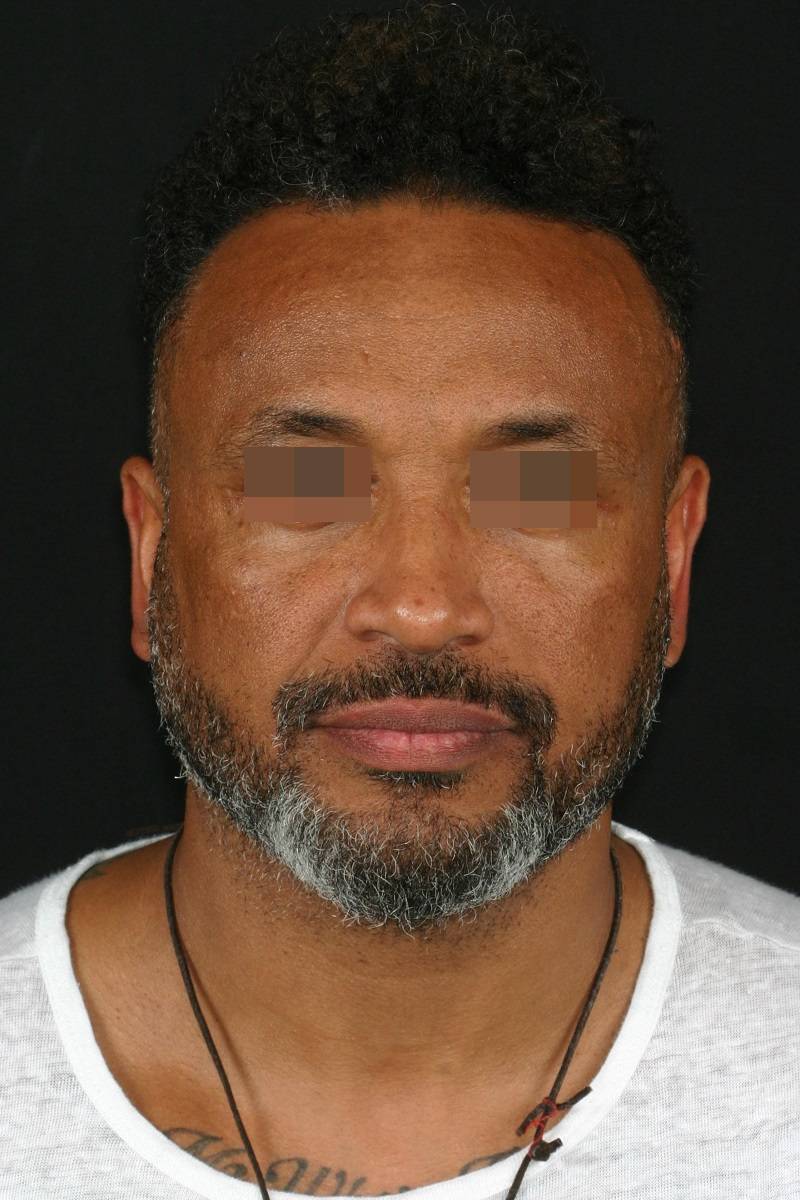 Clinical Cases Orthognathic Surgery - Birbe Clinic