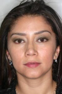 Caso Clínico Rinoplastia​