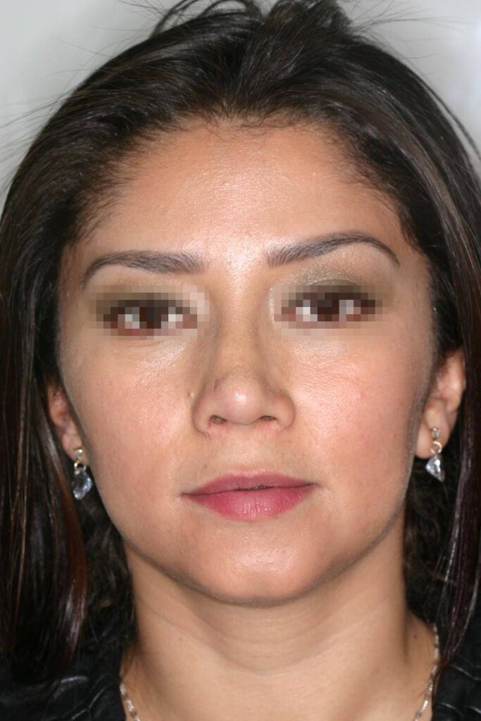 Caso Clínico Rinoplastia​