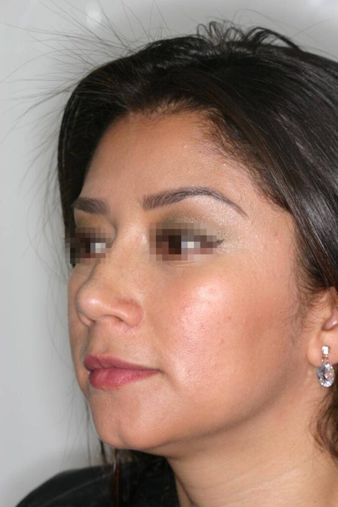 Caso Clínico Rinoplastia​