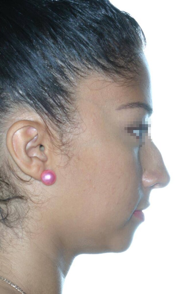 Caso Clínico Rinoplastia​