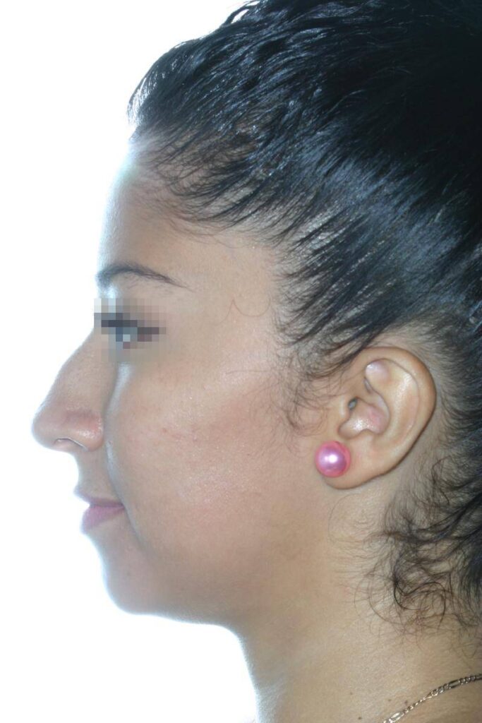 Caso Clínico Rinoplastia​