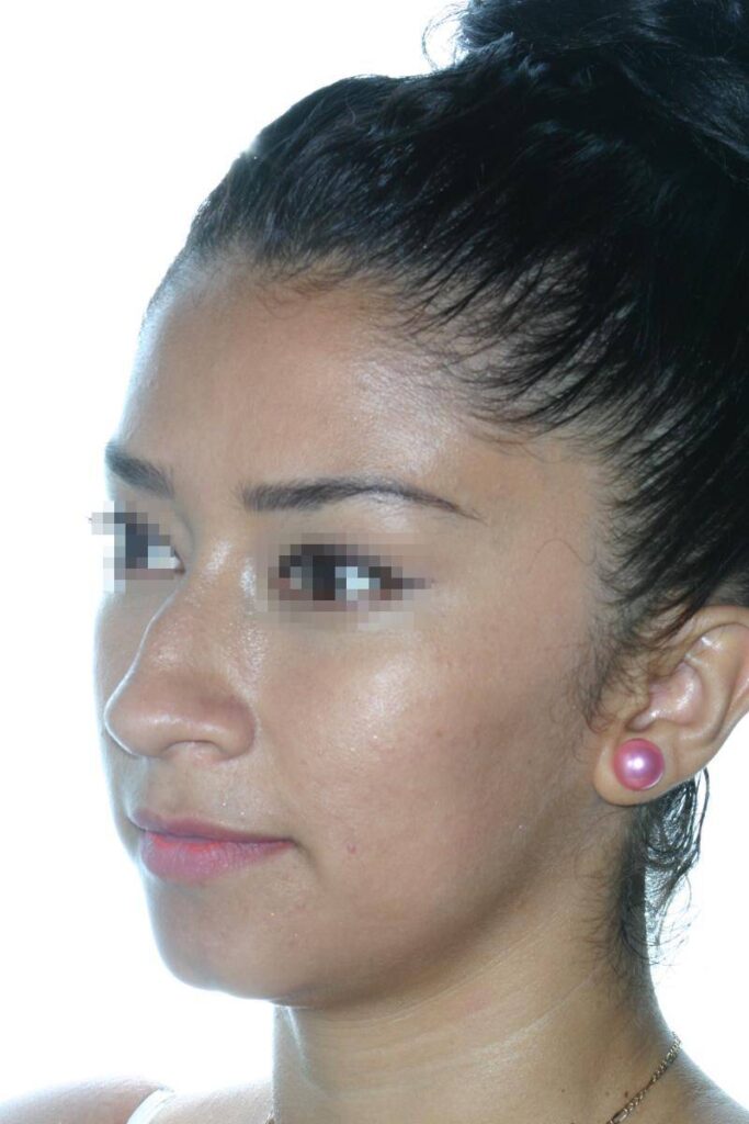 Caso Clínico Rinoplastia​