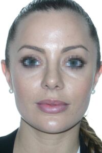 Caso Clínico Rinoplastia​